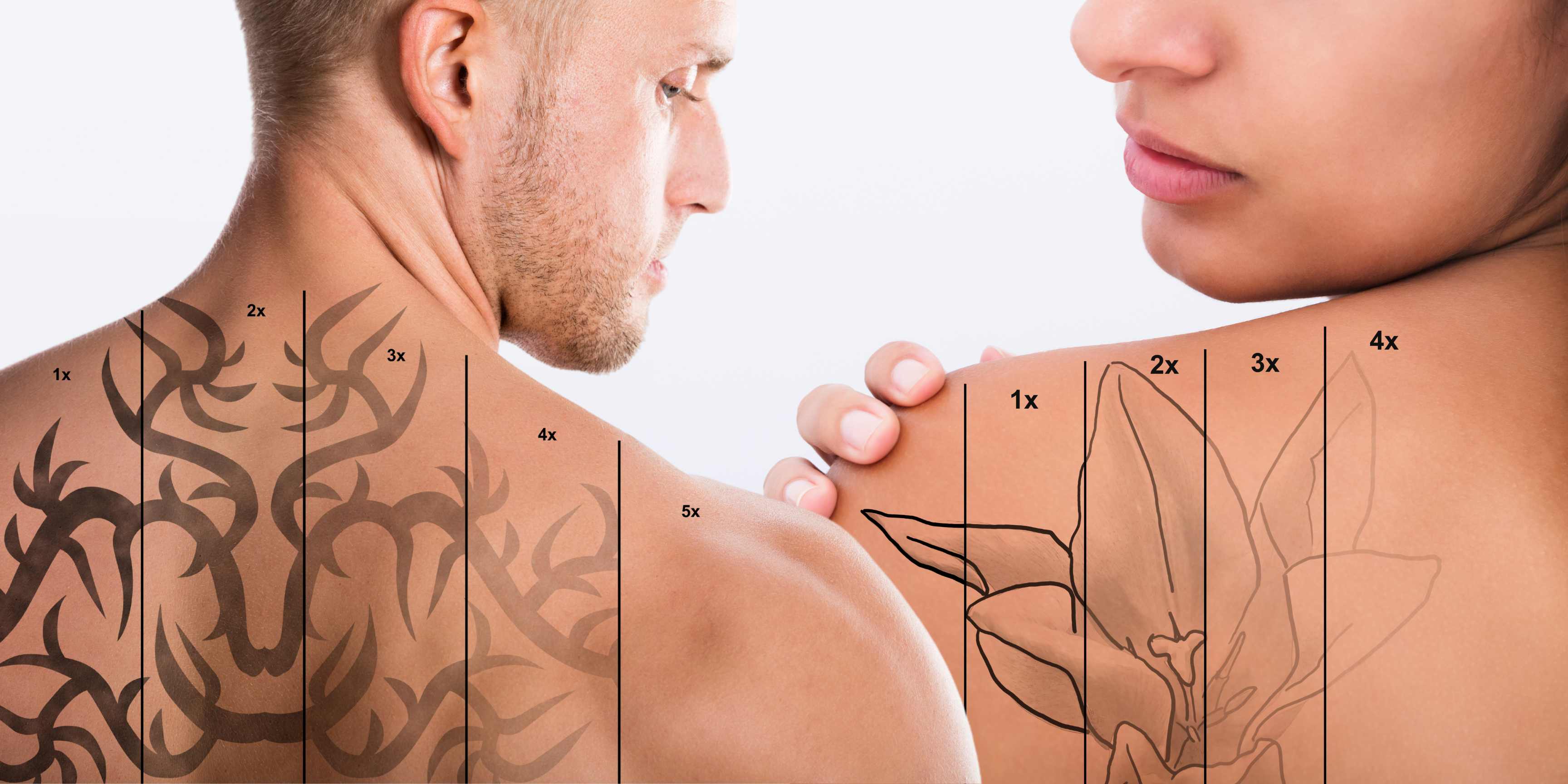 Tattoo Removal Everett WA | Process, Results, Costs and Aftercare