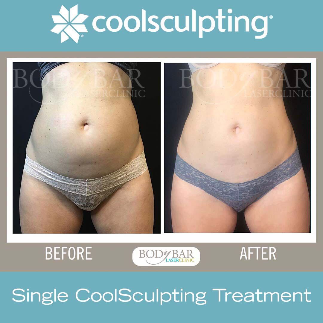 CoolSculpting Port Moody BC  Body Contouring Port Moody BC